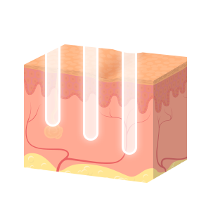 미세 열기둥 (Micro Thermal Zone) 을 이용한 피부 재생의 원리