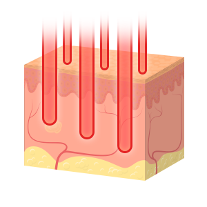 미세 열지역 (Micro Thermal Zone) 을 이용한 피부 재생의 원리