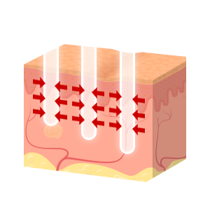 미세 열기둥 (Micro Thermal Zone) 을 이용한 피부 재생의 원리